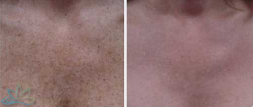 Photo Gallery - Laser Resurfacing Image 01