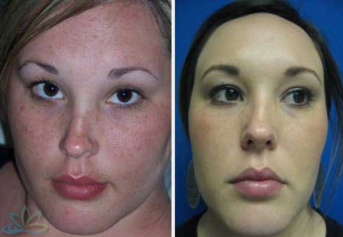 Photo Gallery - Laser Resurfacing Image 02