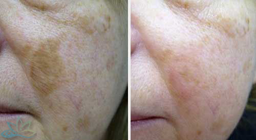 Photo Gallery - Laser Resurfacing Image 03