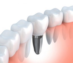 Dental Implants