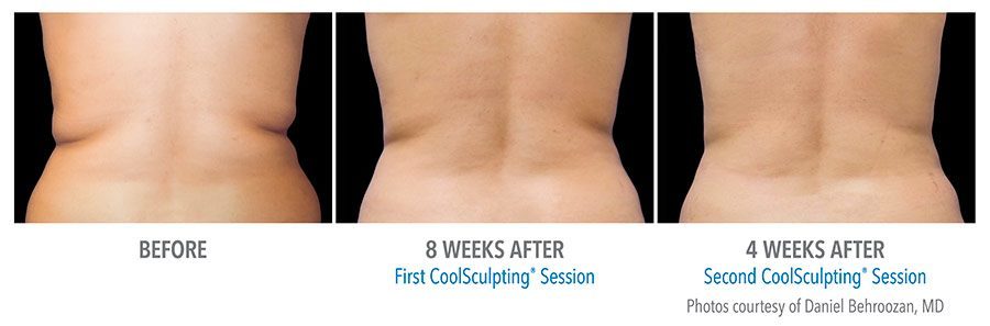 CoolSculpting Bend - Coolsculpting Before and After Case 01