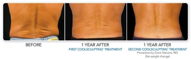 CoolSculpting Bend - Coolsculpting Before and After Case 10