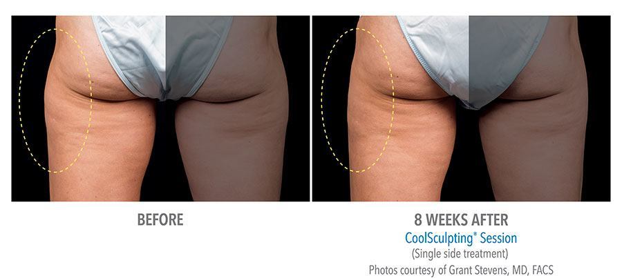 CoolSculpting Bend - Coolsculpting Before and After Case 11