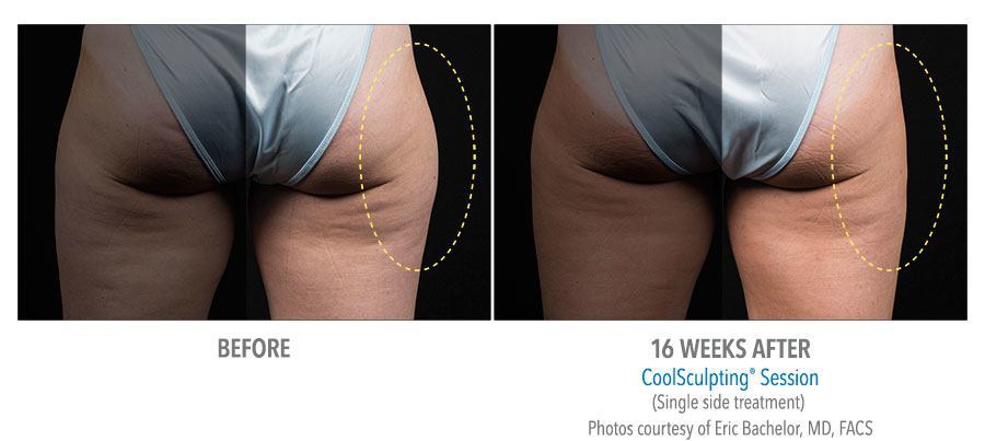 CoolSculpting Bend - Coolsculpting Before and After Case 12