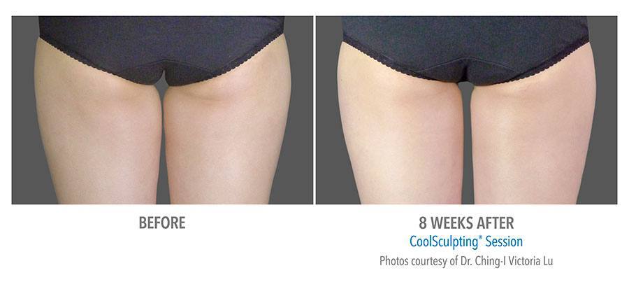 CoolSculpting Bend - Coolsculpting Before and After Case 13