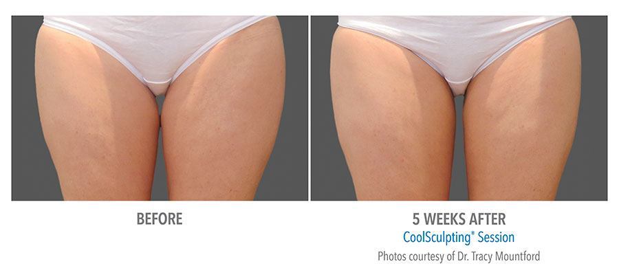 CoolSculpting Bend - Coolsculpting Before and After Case 14