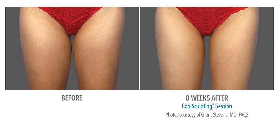 CoolSculpting Bend - Coolsculpting Before and After Case 15