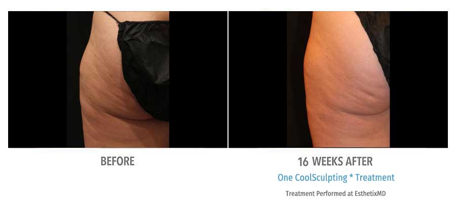 CoolSculpting Bend - Coolsculpting Before and After Case 16