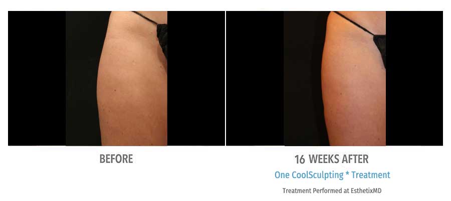 CoolSculpting Bend - Coolsculpting Before and After Case 17
