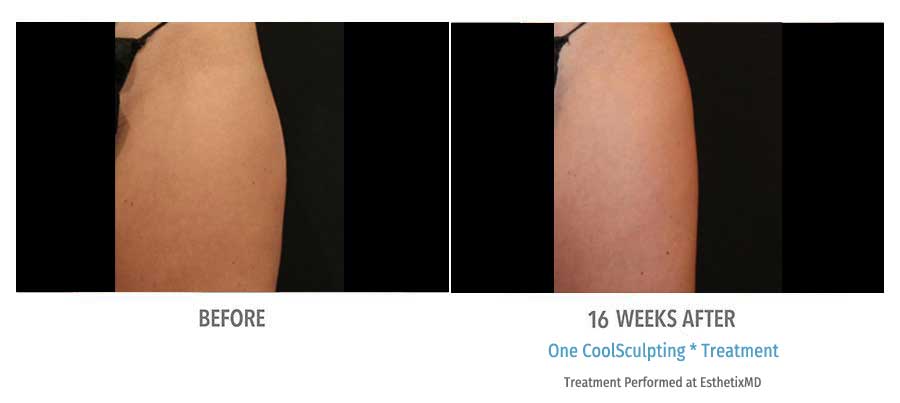 CoolSculpting Bend - Coolsculpting Before and After Case 18