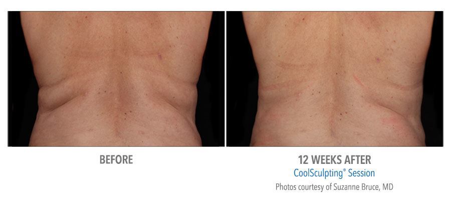 CoolSculpting Bend - Coolsculpting Before and After Case 02
