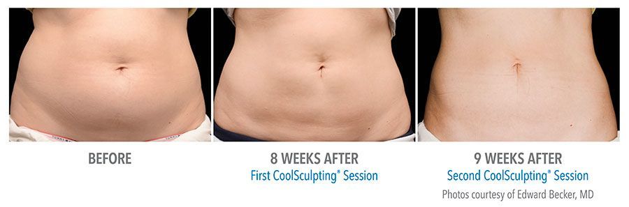 CoolSculpting Bend - Coolsculpting Before and After Case 03