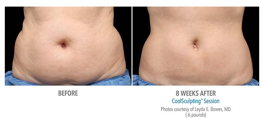 CoolSculpting Bend - Coolsculpting Before and After Case 04