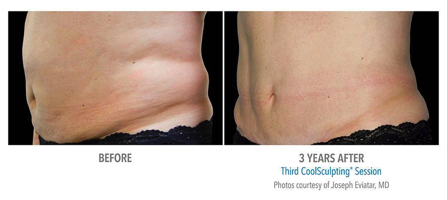 CoolSculpting Bend - Coolsculpting Before and After Case 05