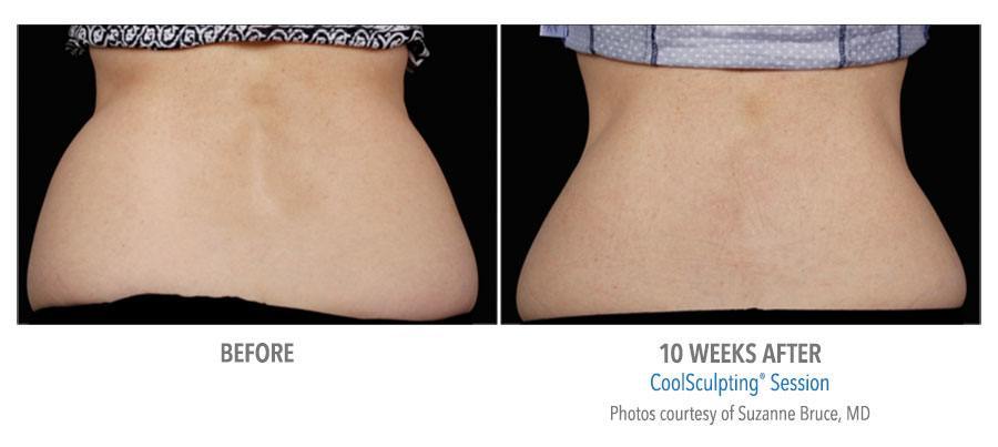 CoolSculpting Bend - Coolsculpting Before and After Case 06