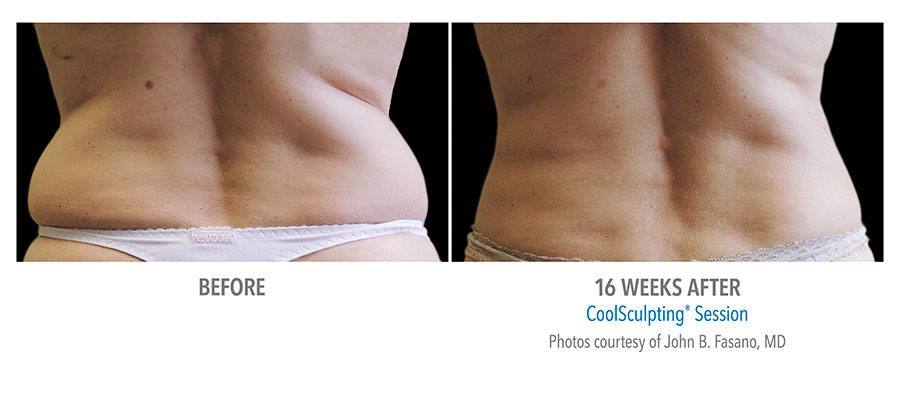 CoolSculpting Bend - Coolsculpting Before and After Case 07