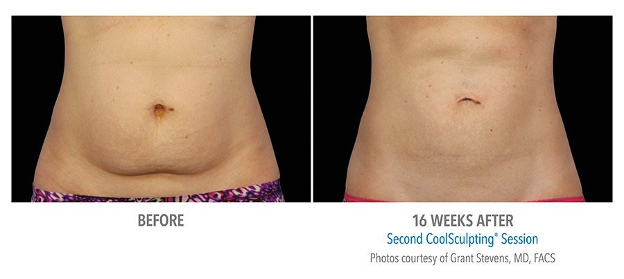 CoolSculpting Bend - Coolsculpting Before and After Case 08