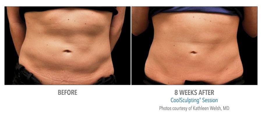 CoolSculpting Bend - Coolsculpting Before and After Case 09