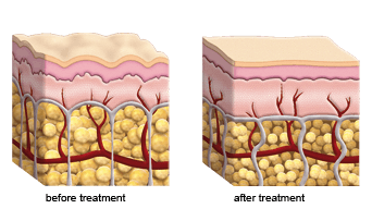 Zwave Bend - Cellulite Reduction Before After