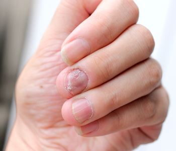 Infected finger
