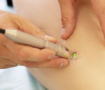 Laser Spider Vein Removal