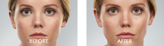Juvederm Voluma XC Before After Case 01