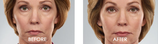 Juvederm Voluma XC Before After Case 02