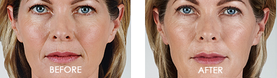 Juvederm Voluma XC Before After Case 05