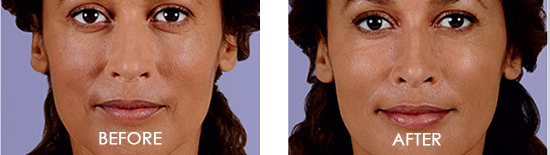 Juvederm Voluma XC Before After Case 06