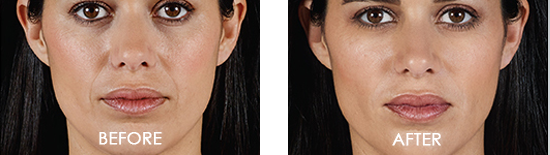 Juvederm Voluma XC Before After Case 07
