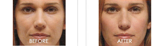 Belotero Balance Before After 01
