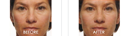 Belotero Balance Before After 02