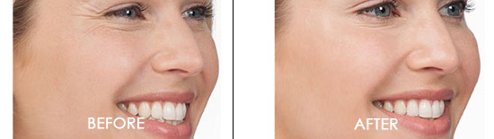 Botox Before After 01