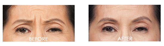 Botox Before After 10