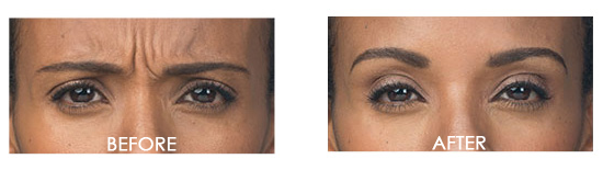 Botox Before After 11