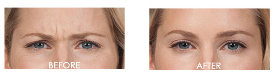 Botox Before After 12