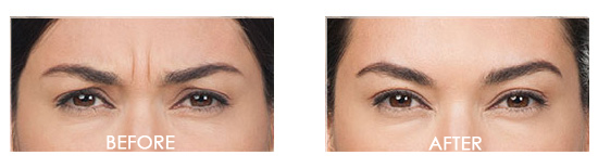 Botox Before After 13