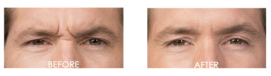 Botox Before After 14