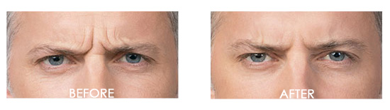 Botox Before After 15