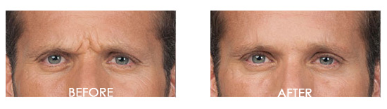 Botox Before After 16