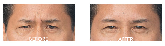 Botox Before After 17