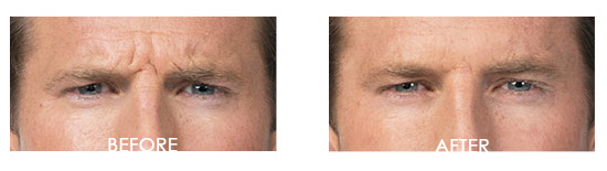 Botox Before After 18