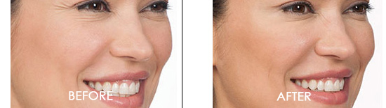 Botox Before After 02