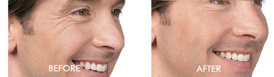 Botox Before After 03