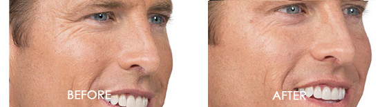 Botox Before After 04