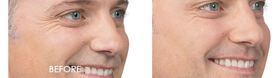 Botox Before After 05
