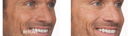Botox Before After 06