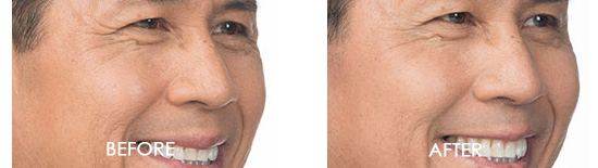 Botox Before After 07