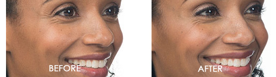 Botox Before After 08