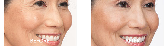 Botox Before After 09